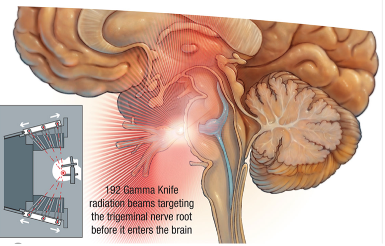 facial-pain-and-trigeminal-neuralgia-union-hospital