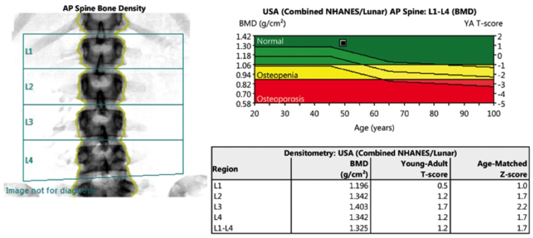 仁安医疗造影体检中心 | 骨质密度检查 (DEXA/DXA) | AP Spine Bone Density