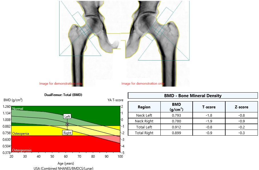 仁安医疗造影体检中心 | 骨质密度检查 (DEXA/DXA) | Bone Mineral Density (BMD)