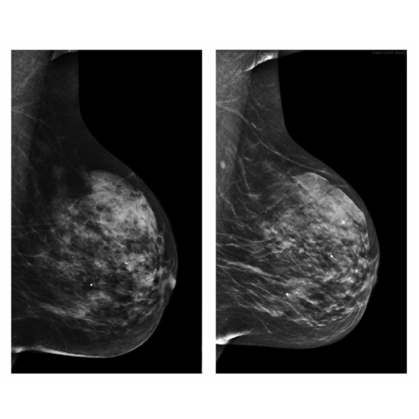 Union Imaging & Healthcheck Centre | Mammography | 2D mammography vs 3D mammography