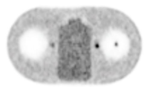 Union Imaging & Healthcheck Centre | Positron Emission Tomography-Computed Tomography (PET-CT) | Image with previous generation reconstruction algorithm