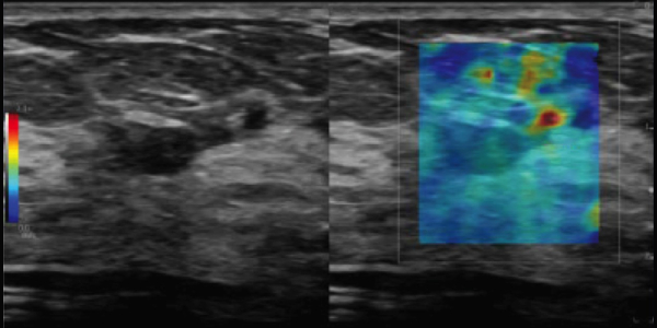 Union Imaging & Healthcheck Centre | Ultrasound (US) | 2D shear wave elastography