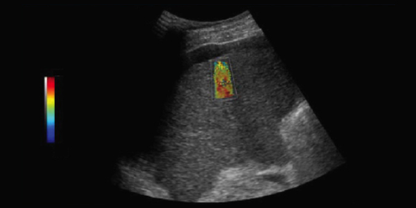 Union Imaging & Healthcheck Centre | Ultrasound (US) | 2D shear wave elastography