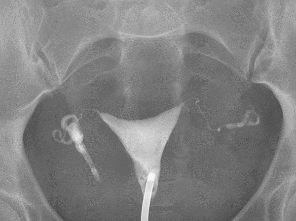 Union Imaging & Healthcheck Centre | X-ray | Hysterosalpingogram (HSG)