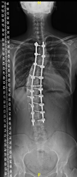 Union Imaging & Healthcheck Centre | X-ray | Whole spine scanogram and lower limbs scanogram